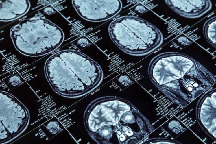 Inteligência-artificial-pode-ajudar-no-sintomas-de-alzheimer